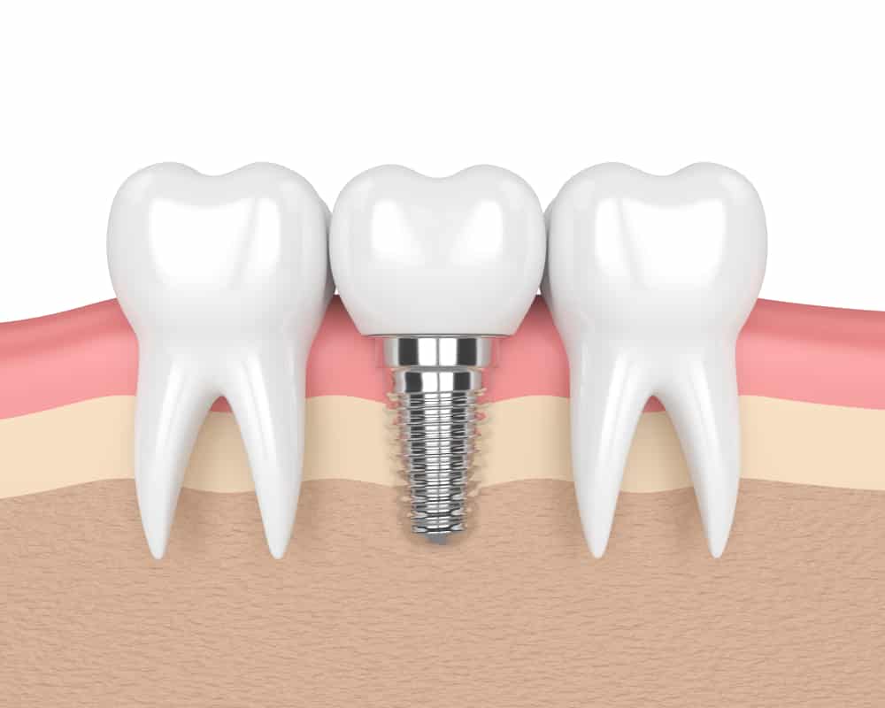 lower dental implants cost        <h3 class=