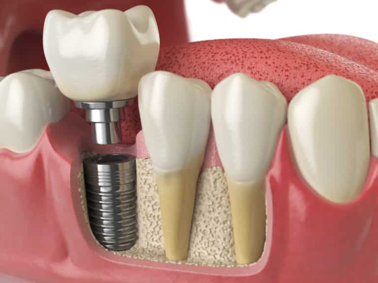 6 Types Of Implant Crowns For Your Teeth